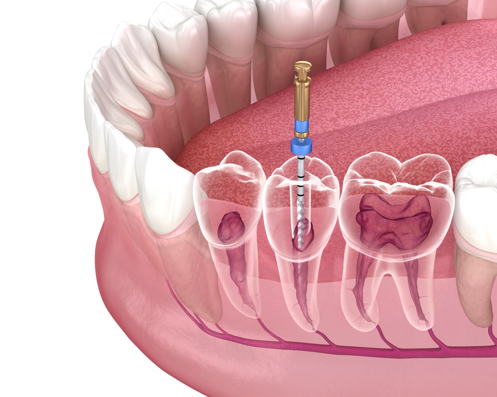 root canal therapy example image