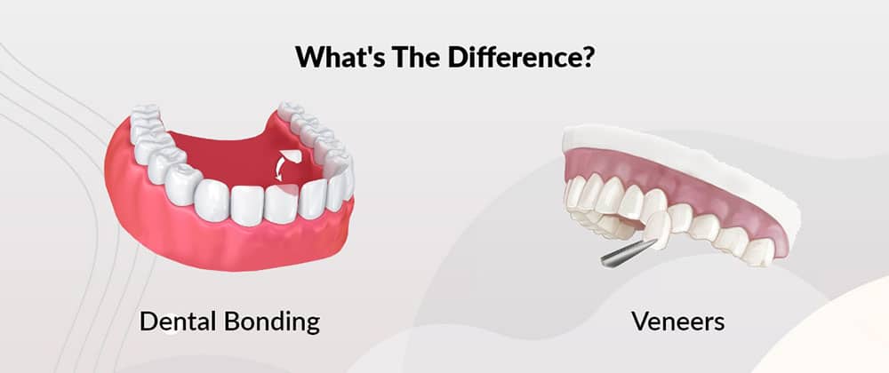 A visual diagram comparing two cosmetic treatments, showing how dental bonding adds material directly to a tooth, and a veneer covers the front surface of a tooth.