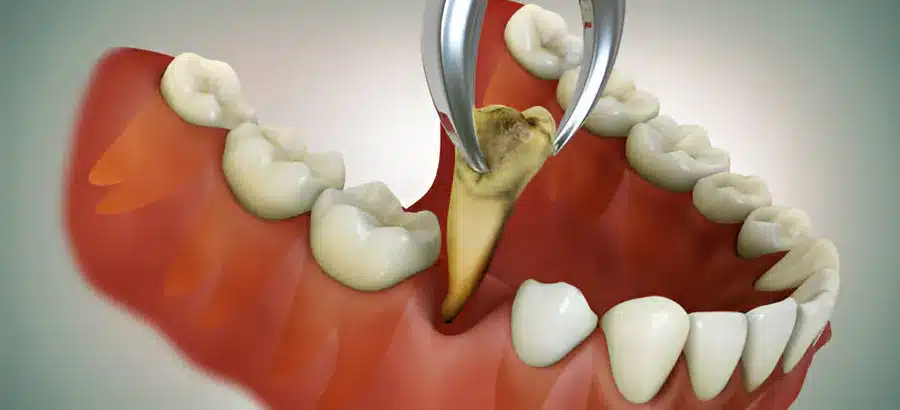 Illustration showing a dentist removing a severely damaged tooth during an emergency tooth extraction procedure